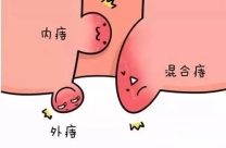 痔疮护理市场产品类型梳理：从传统剂型到新材料应用，患者选择需“对症下药”